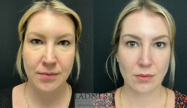 About Chloe Ting Plastic Surgery : Before and After