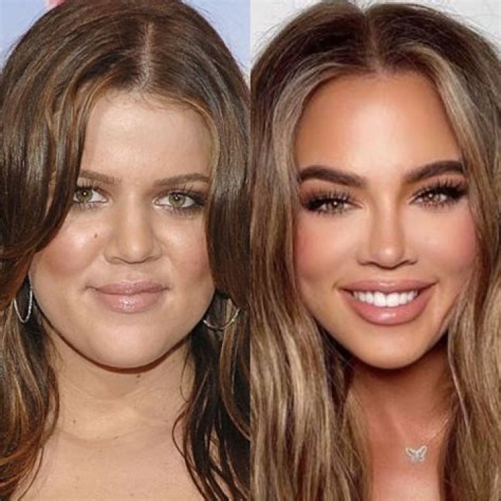 Khloe Kardashian's plastic surgery secrets revealed